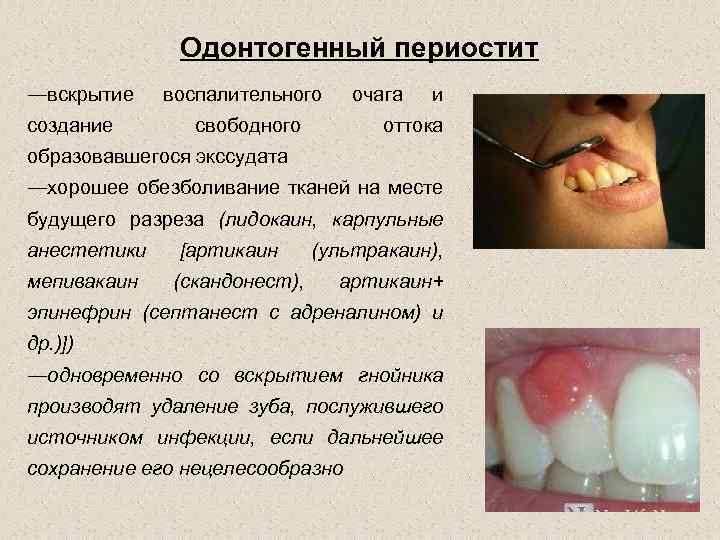 Одонтогенный периостит ―вскрытие создание воспалительного очага свободного и оттока образовавшегося экссудата ―хорошее обезболивание тканей