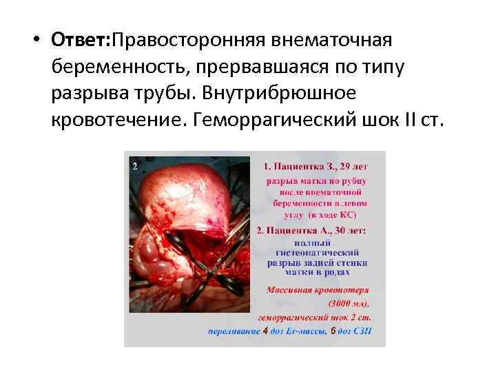  • Ответ: Правосторонняя внематочная беременность, прервавшаяся по типу разрыва трубы. Внутрибрюшное кровотечение. Геморрагический