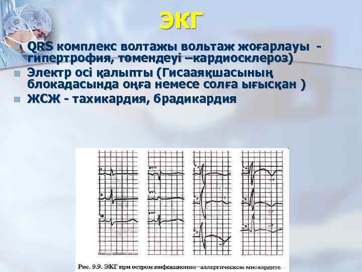 ЭКГ n n n QRS комплекс волтажы вольтаж жоғарлауы гипертрофия, төмендеуі –кардиосклероз) Электр осі