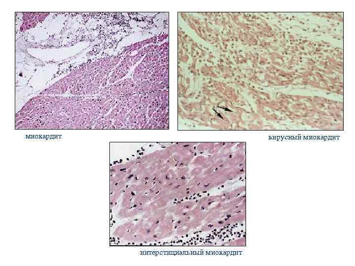 миокардит вирусный миокардит интерстициальный миокардит 
