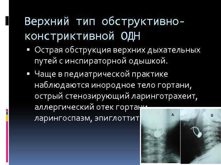 Верхний тип обструктивноконстриктивной ОДН Острая обструкция верхних дыхательных путей с инспираторной одышкой. Чаще в