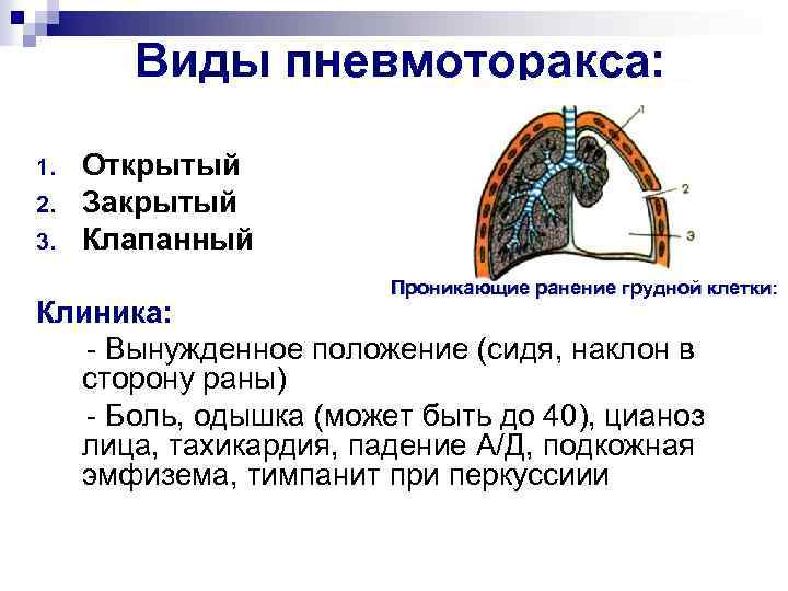 Пневмоторакс картинки для презентации