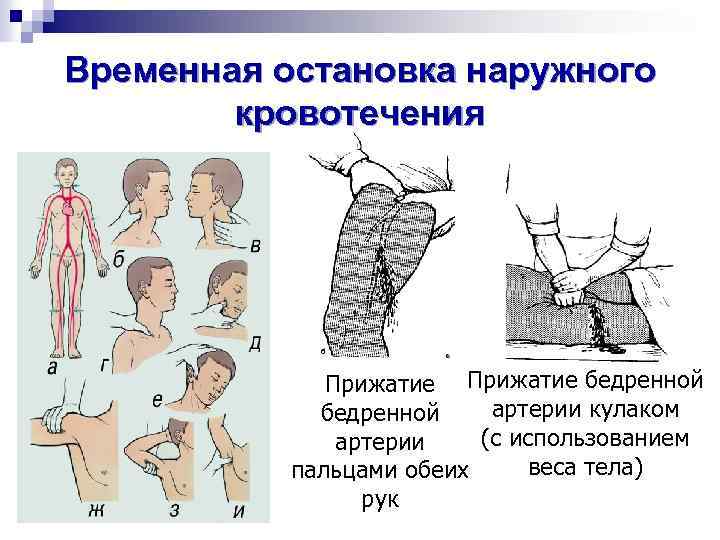 Фото пальцевое прижатие артерии