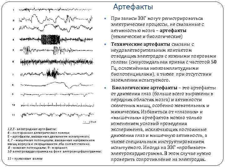 Артефакты При записи ЭЭГ могут регистрироваться электрические процессы, не связанные с активностью мозга –