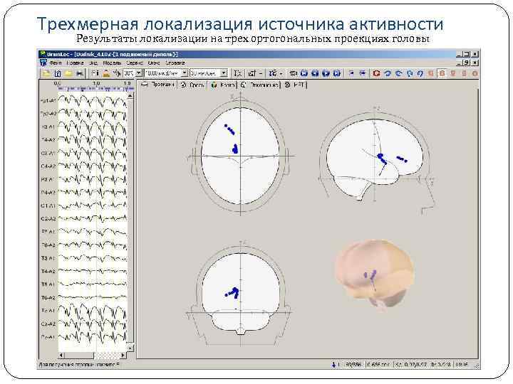  Трехмерная локализация источника активности Результаты локализации на трех ортогональных проекциях головы 