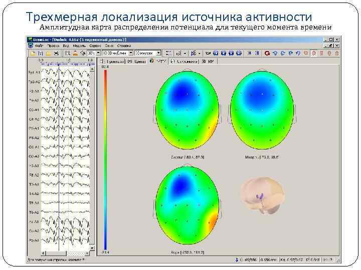  Трехмерная локализация источника активности Амплитудная карта распределения потенциала для текущего момента времени 