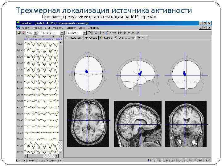 Трехмерная локализация источника активности Просмотр результатов локализации на МРТ срезах 