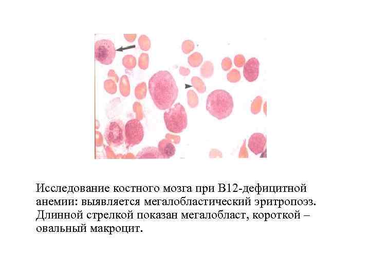В12 при железодефицитной анемии. Мегалобластная анемия костный мозг. Картина костного мозга при б12 дефицитной анемии. Мегалобласты при в12 дефицитной анемии. Костный мозг при б12 дефицитной анемии.