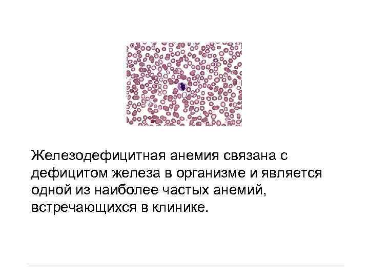 Железодефицитная анемия связана с дефицитом железа в организме и является одной из наиболее частых