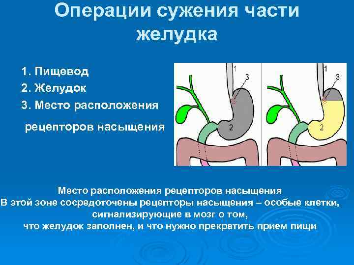 Операции сужения части желудка 1. Пищевод 2. Желудок 3. Место расположения рецепторов насыщения В