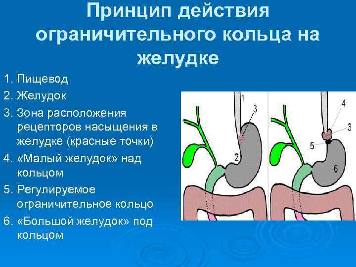 Принцип действия ограничительного кольца на желудке 1. Пищевод 2. Желудок 3. Зона расположения рецепторов