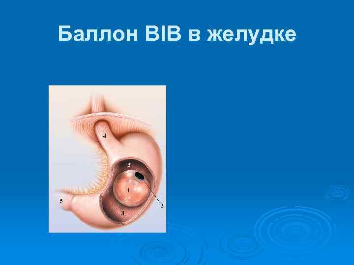 Баллон BIB в желудке 