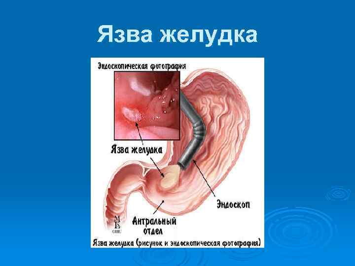 Язва желудка 