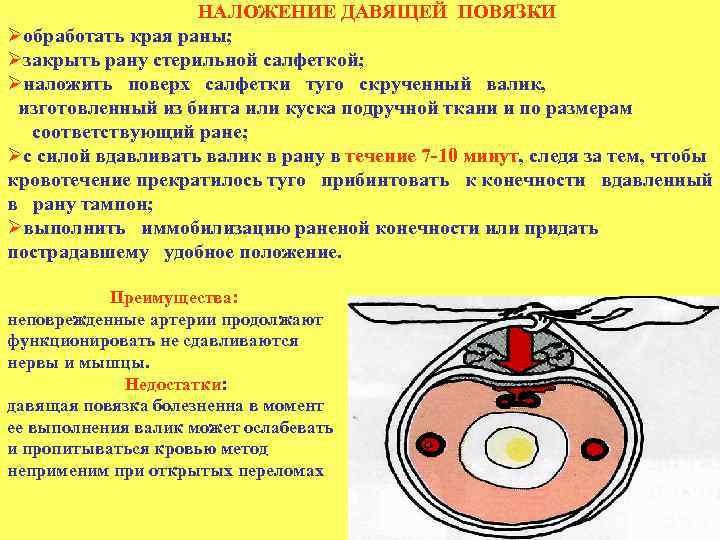 НАЛОЖЕНИЕ ДАВЯЩЕЙ ПОВЯЗКИ Øобработать края раны; Øзакрыть рану стерильной салфеткой; Øналожить поверх салфетки туго