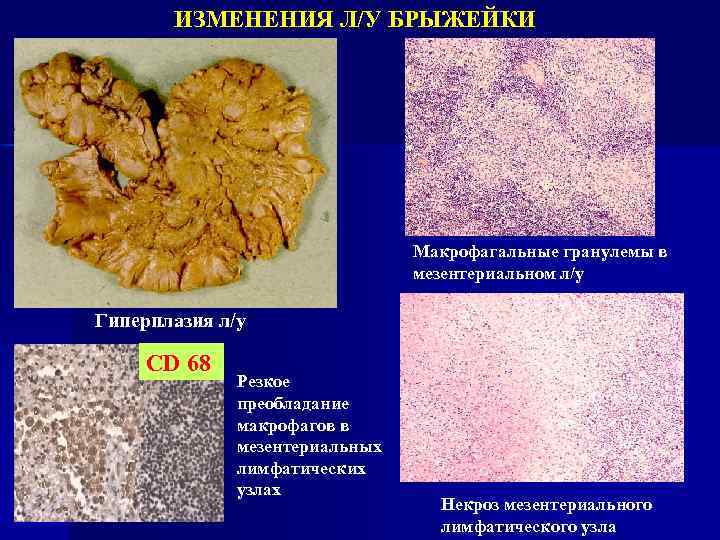 ИЗМЕНЕНИЯ Л/У БРЫЖЕЙКИ Макрофагальные гранулемы в мезентериальном л/у Гиперплазия л/у CD 68 Резкое преобладание