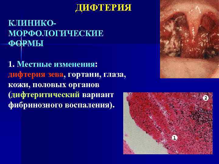 ДИФТЕРИЯ КЛИНИКОМОРФОЛОГИЧЕСКИЕ ФОРМЫ 1. Местные изменения: дифтерия зева, гортани, глаза, кожи, половых органов (дифтеритический