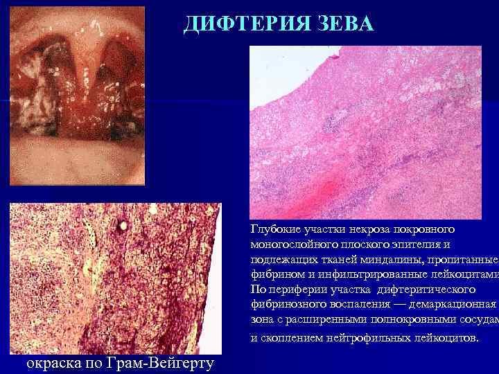 ДИФТЕРИЯ ЗЕВА Глубокие участки некроза покровного моногослойного плоского эпителия и подлежащих тканей миндалины, пропитанные