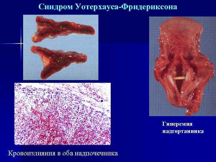  Синдром Уотерхауса-Фридериксона Гиперемия надгортанника Кровоизлияния в оба надпочечника 