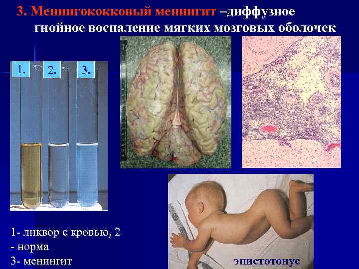 3. Менингококковый менингит –диффузное гнойное воспаление мягких мозговых оболочек 1. 2. 3. 1 -
