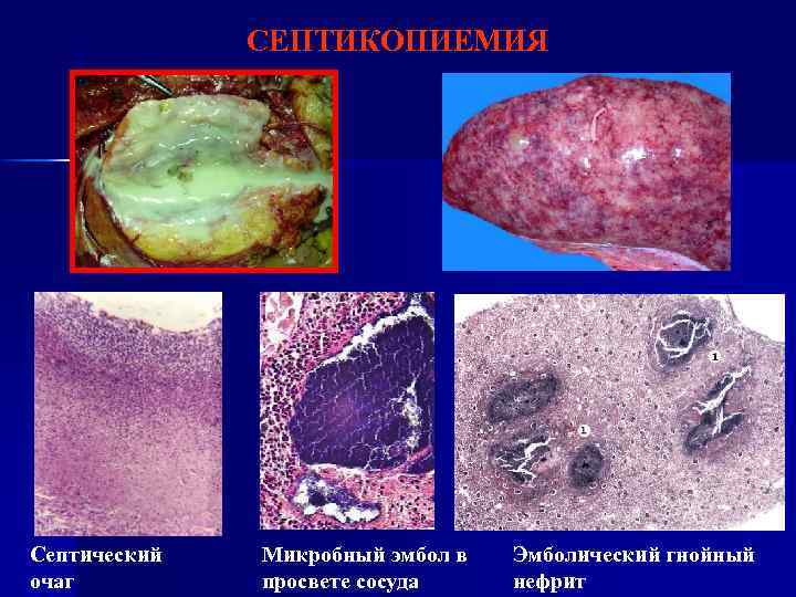 СЕПТИКОПИЕМИЯ Септический очаг Микробный эмбол в просвете сосуда Эмболический гнойный нефрит 