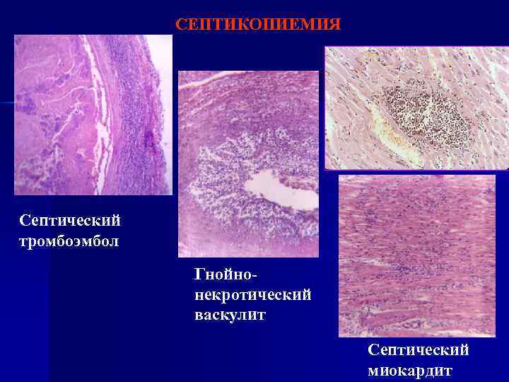 СЕПТИКОПИЕМИЯ Септический тромбоэмбол Гнойнонекротический васкулит Септический миокардит 