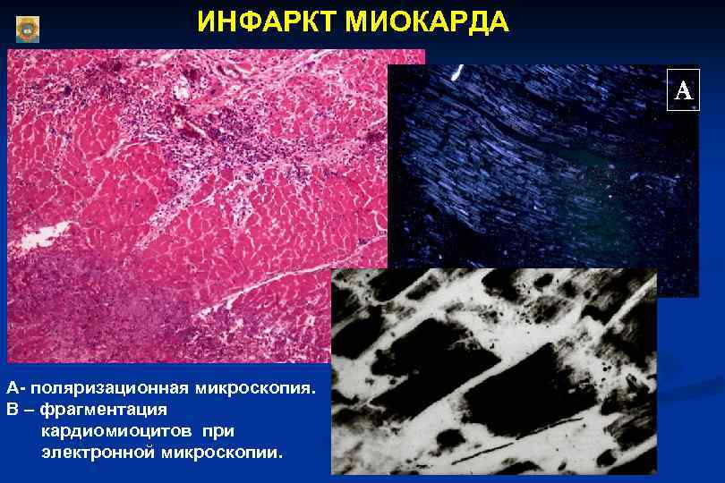 ИНФАРКТ МИОКАРДА А А- поляризационная микроскопия. В – фрагментация кардиомиоцитов при электронной микроскопии. 