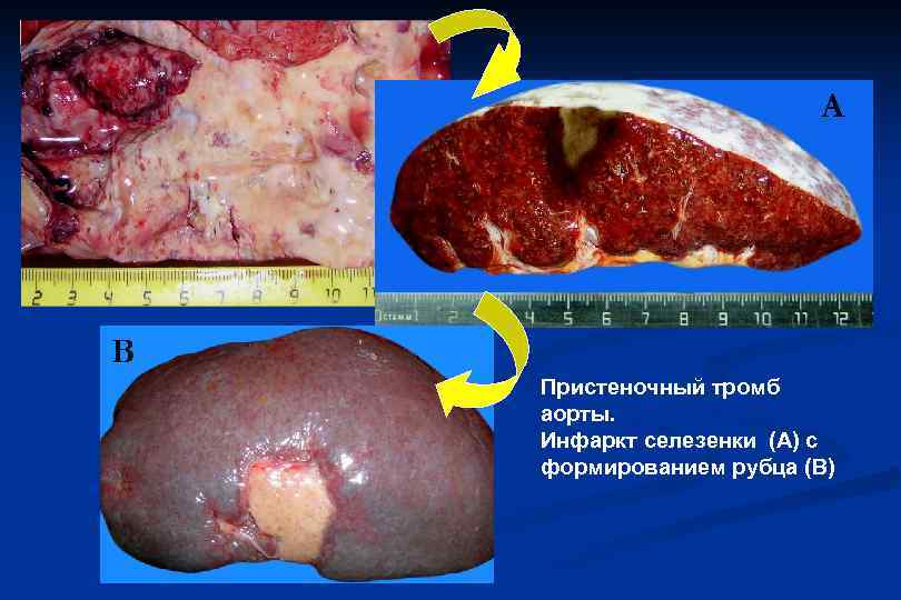 А В Пристеночный тромб аорты. Инфаркт селезенки (А) с формированием рубца (В) 