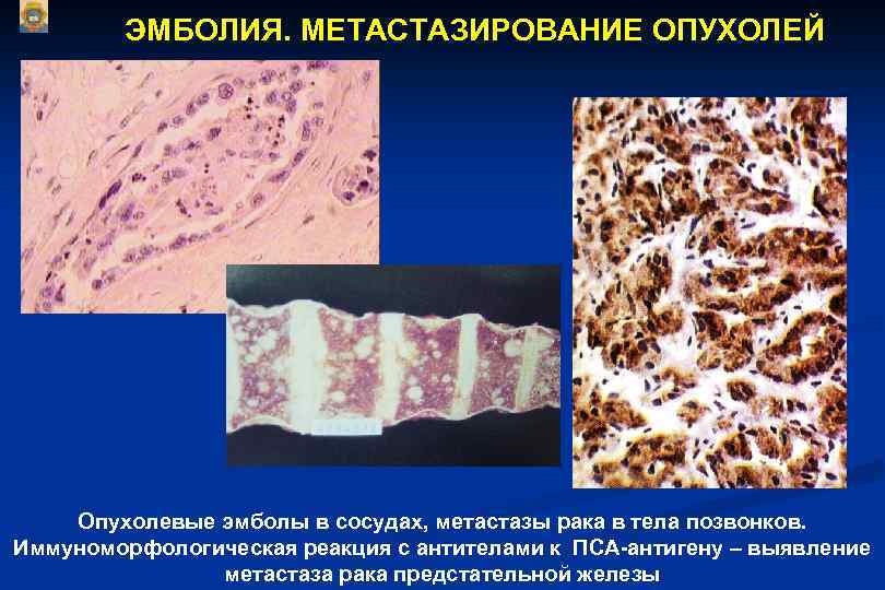 ЭМБОЛИЯ. МЕТАСТАЗИРОВАНИЕ ОПУХОЛЕЙ Опухолевые эмболы в сосудах, метастазы рака в тела позвонков. Иммуноморфологическая реакция