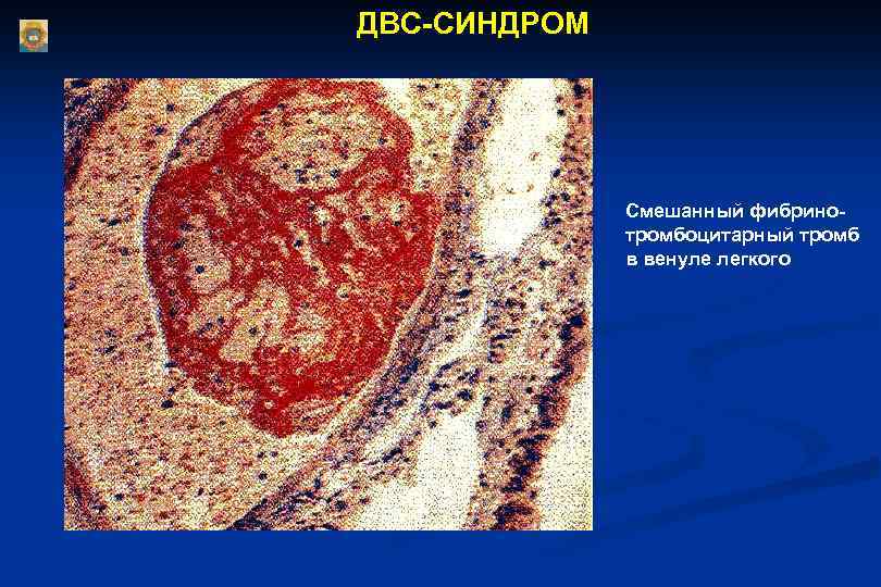 ДВС-СИНДРОМ Смешанный фибринотромбоцитарный тромб в венуле легкого 