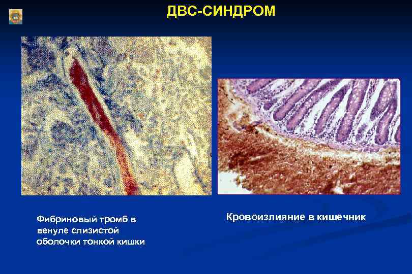 ДВС-СИНДРОМ Фибриновый тромб в венуле слизистой оболочки тонкой кишки Кровоизлияние в кишечник 