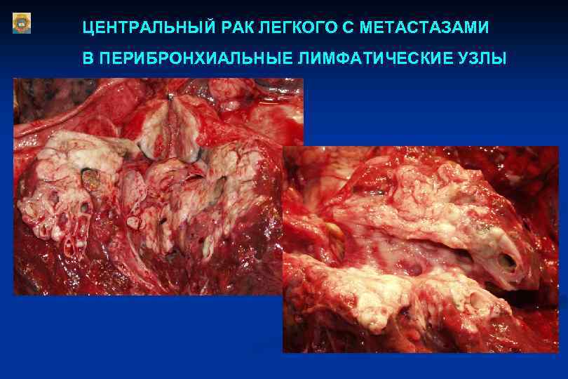 ЦЕНТРАЛЬНЫЙ РАК ЛЕГКОГО С МЕТАСТАЗАМИ В ПЕРИБРОНХИАЛЬНЫЕ ЛИМФАТИЧЕСКИЕ УЗЛЫ 