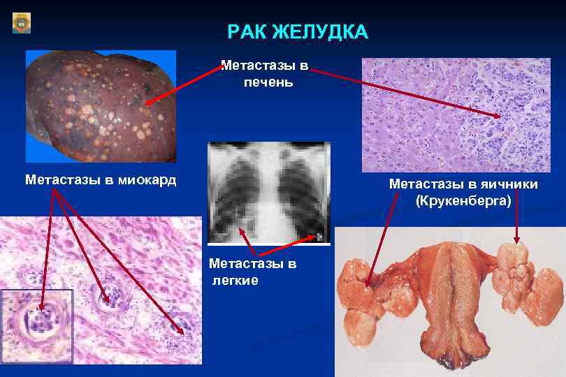 РАК ЖЕЛУДКА Метастазы в печень Метастазы в миокард Метастазы в яичники (Крукенберга) Метастазы в
