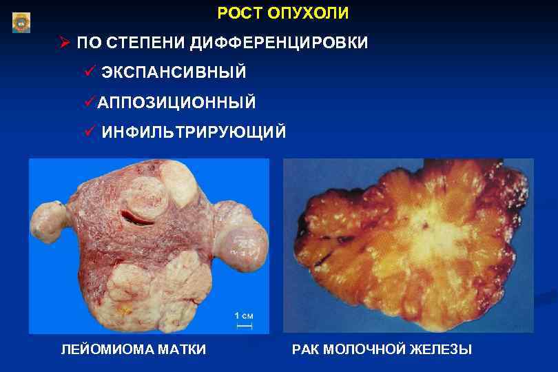 Экспансивный рост опухоли рисунок