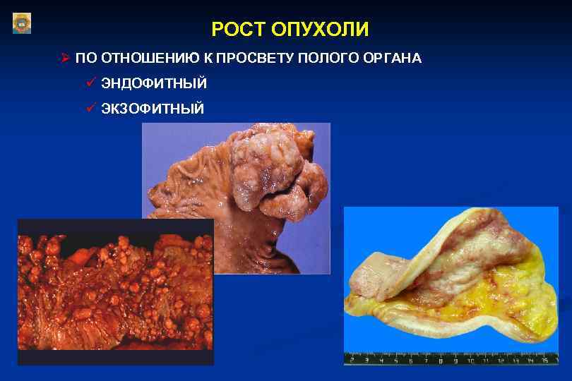 РОСТ ОПУХОЛИ Ø ПО ОТНОШЕНИЮ К ПРОСВЕТУ ПОЛОГО ОРГАНА ü ЭНДОФИТНЫЙ ü ЭКЗОФИТНЫЙ 