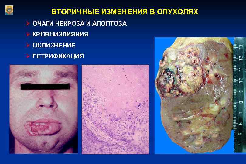 ВТОРИЧНЫЕ ИЗМЕНЕНИЯ В ОПУХОЛЯХ Ø ОЧАГИ НЕКРОЗА И АПОПТОЗА Ø КРОВОИЗЛИЯНИЯ Ø ОСЛИЗНЕНИЕ Ø