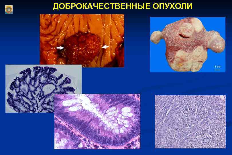 ДОБРОКАЧЕСТВЕННЫЕ ОПУХОЛИ 