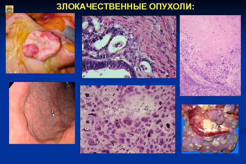 ЗЛОКАЧЕСТВЕННЫЕ ОПУХОЛИ: 