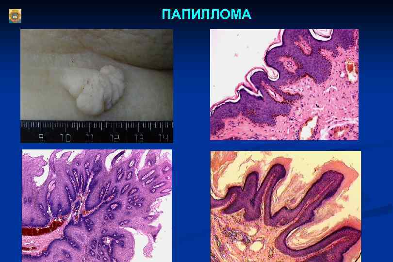 ПАПИЛЛОМА 