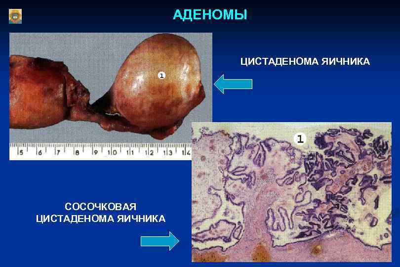 АДЕНОМЫ ЦИСТАДЕНОМА ЯИЧНИКА СОСОЧКОВАЯ ЦИСТАДЕНОМА ЯИЧНИКА 