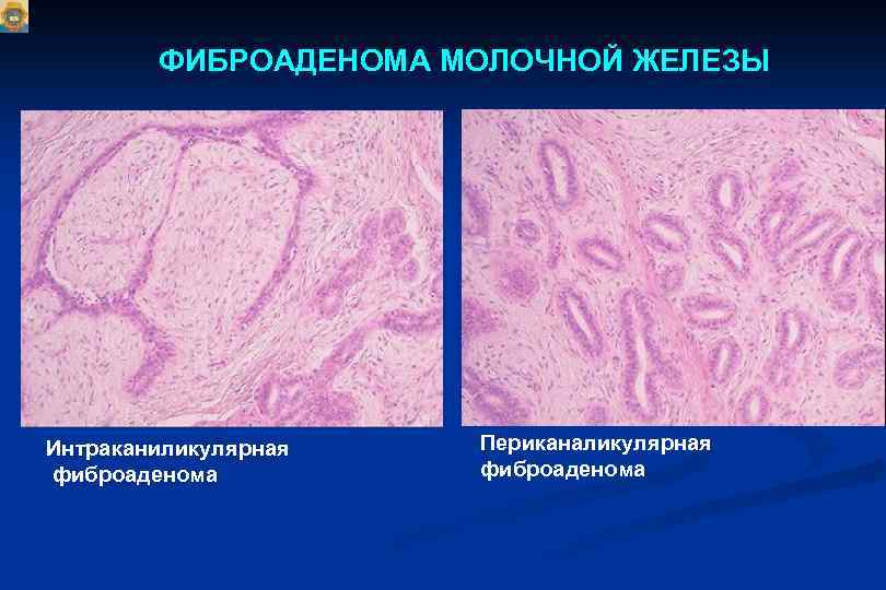 Фиброаденома фото после операции