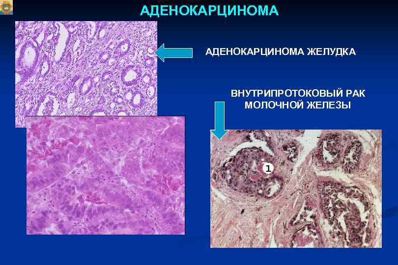 АДЕНОКАРЦИНОМА ЖЕЛУДКА ВНУТРИПРОТОКОВЫЙ РАК МОЛОЧНОЙ ЖЕЛЕЗЫ 
