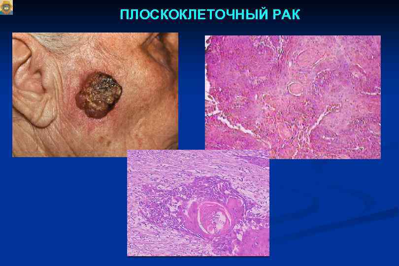 ПЛОСКОКЛЕТОЧНЫЙ РАК 