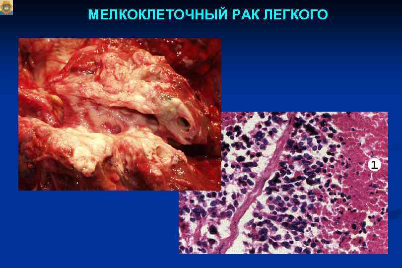 МЕЛКОКЛЕТОЧНЫЙ РАК ЛЕГКОГО 