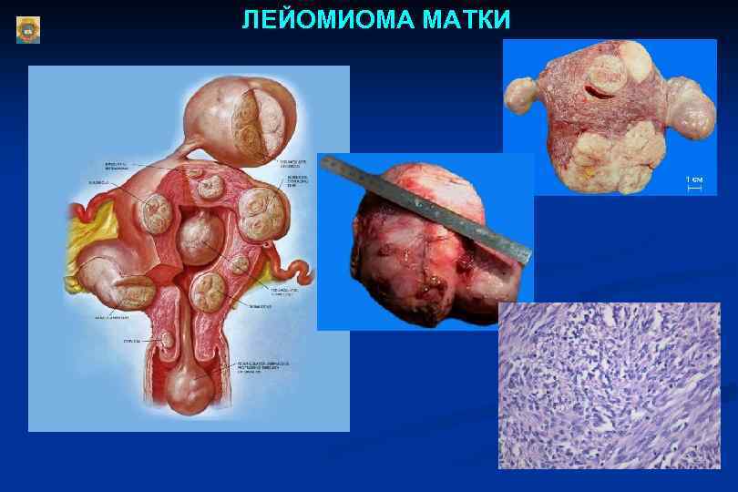 ЛЕЙОМИОМА МАТКИ 