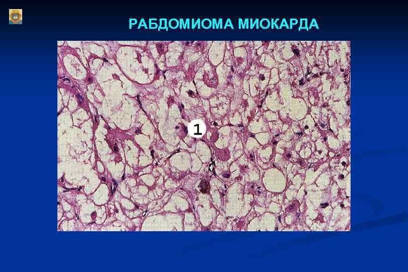 РАБДОМИОМА МИОКАРДА 