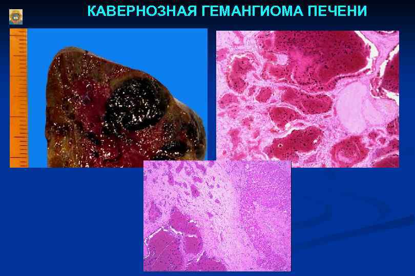 КАВЕРНОЗНАЯ ГЕМАНГИОМА ПЕЧЕНИ 