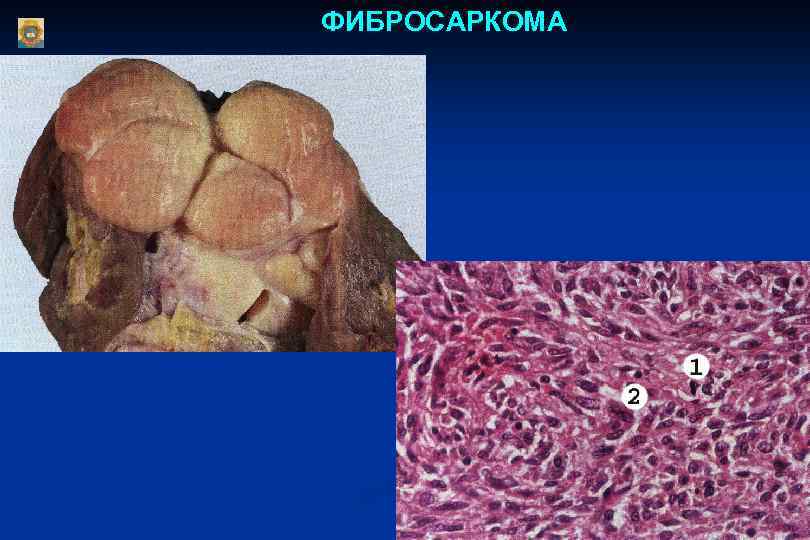 Фибросаркома микропрепарат рисунок