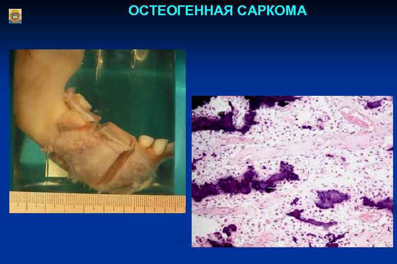 ОСТЕОГЕННАЯ САРКОМА 