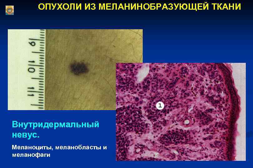 ОПУХОЛИ ИЗ МЕЛАНИНОБРАЗУЮЩЕЙ ТКАНИ Внутридермальный невус. Меланоциты, меланобласты и меланофаги 