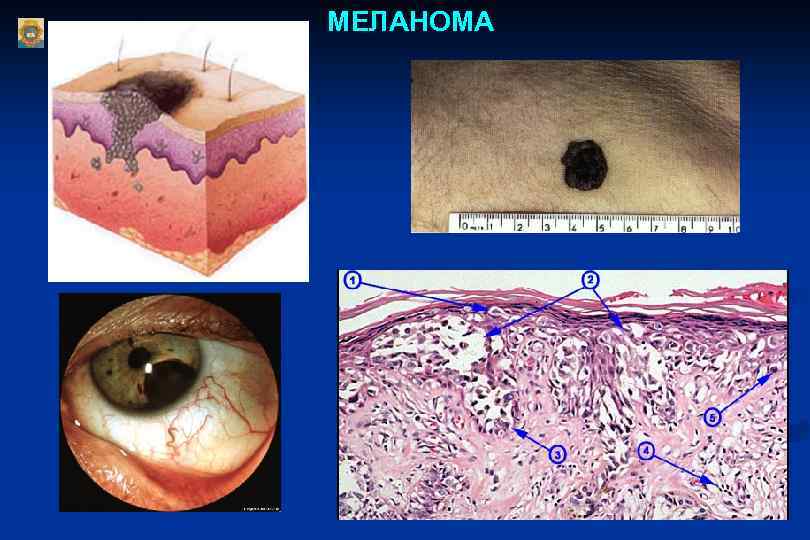 МЕЛАНОМА 